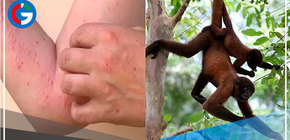 La OMS rebautiza la viruela del mono para evitar estigmatización a primates