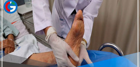 ¿Cómo prevenir y disminuir el riesgo de una amputación? 