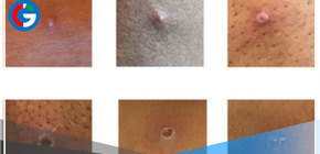 Israel y Suiza confirman primer caso de Viruela del Mono