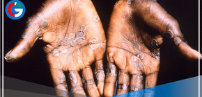 Más de 200 casos de la nueva Viruela del Mono confirmados en 19 países 