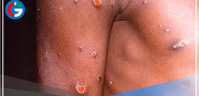 Mexicanos confirman primer caso de viruela del mono en su país 