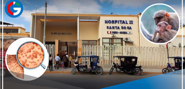 Investigan posible caso de viruela del mono en hombre de 70 años en Piura