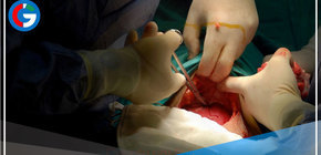 México: Médicos le cortan oreja a un recién nacido tras practicar una cesárea en pleno apagón 