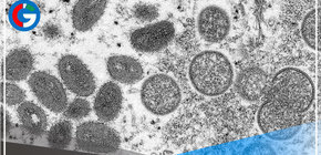 Ya son más de 700 casos de viruela del mono a nivel global 