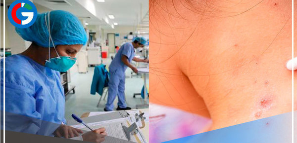 Viruela del mono: aumentan a 112 los casos  en el país