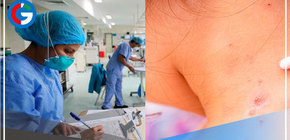  Viruela del mono: aumentan a 157 los casos en el Perú