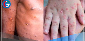 Activan a su máximo nivel de alerta por la viruela del mono