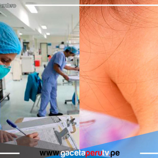  Viruela del mono: aumentan a 157 los casos en el Perú