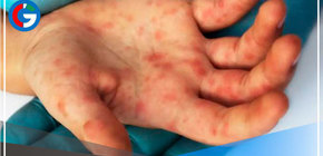 Viruela del mono: contacto sexual sería la principal vía de contagio en Perú