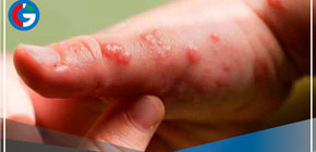 Reporta 15 casos de Viruela del Mono en 5 distritos de Lima Metropolitana 