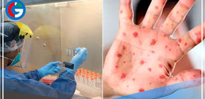 Aumentan a 712 los casos de Viruela del Mono, confirmados en 15 regiones del Perú