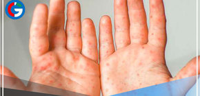 Viruela nueva: el 64.1 % de infectados en el Perú son personas con VIH 