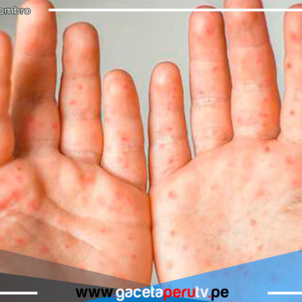 Viruela nueva: el 64.1 % de infectados en el Perú son personas con VIH 