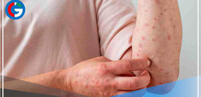 Viruela del mono: 324 casos confirmados en el Perú