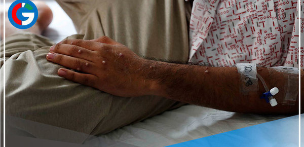 Viruela símica: 1,964 casos en Perú