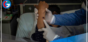 Viruela símica: 2,015 casos en Perú