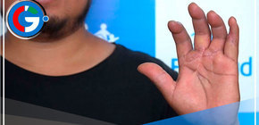 Lima: Reconstruyen mano a mecánico con exitoso reimplante de dedos 