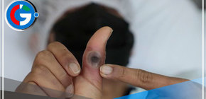 Viruela del Mono:  ¿Cuáles son sus síntomas y cómo se evita? 