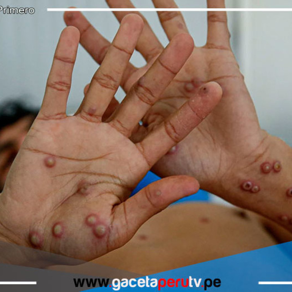 Viruela del mono: Declaran nuevamente como emergencia internacional de salud pública