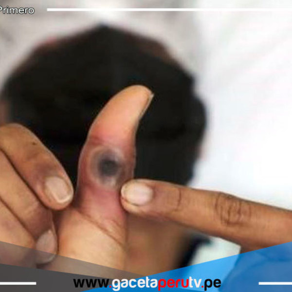 Viruela símica: Actualizarán plan de respuesta en prevención a nuevo linaje 