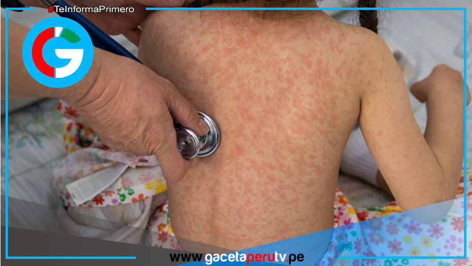 México: Sarampión causa cuatro muertes y 1,629 contagios confirmados