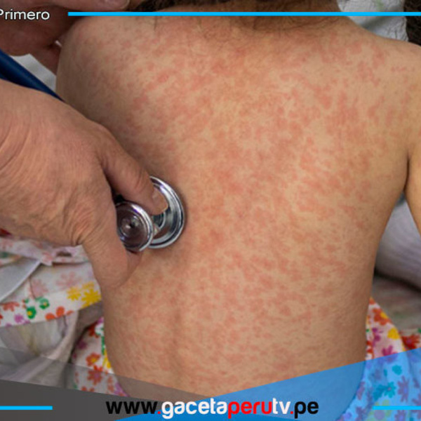 México: Sarampión causa cuatro muertes y 1,629 contagios confirmados