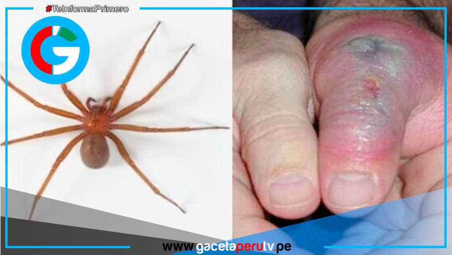 INS advierte aumento de mordeduras de araña casera