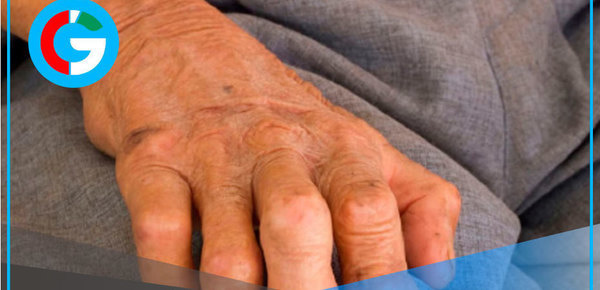 Lepra es curable con tratamiento gratuito, alerta OMS y Minsa