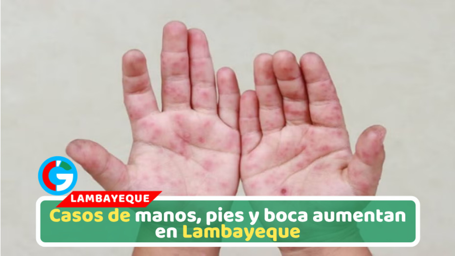 Lambayeque reporta más de 300 casos de manos, pies y boca